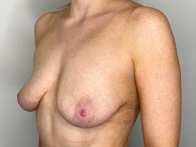Breast Augmentation Before & After Gallery - Patient 147376294 - Image 1