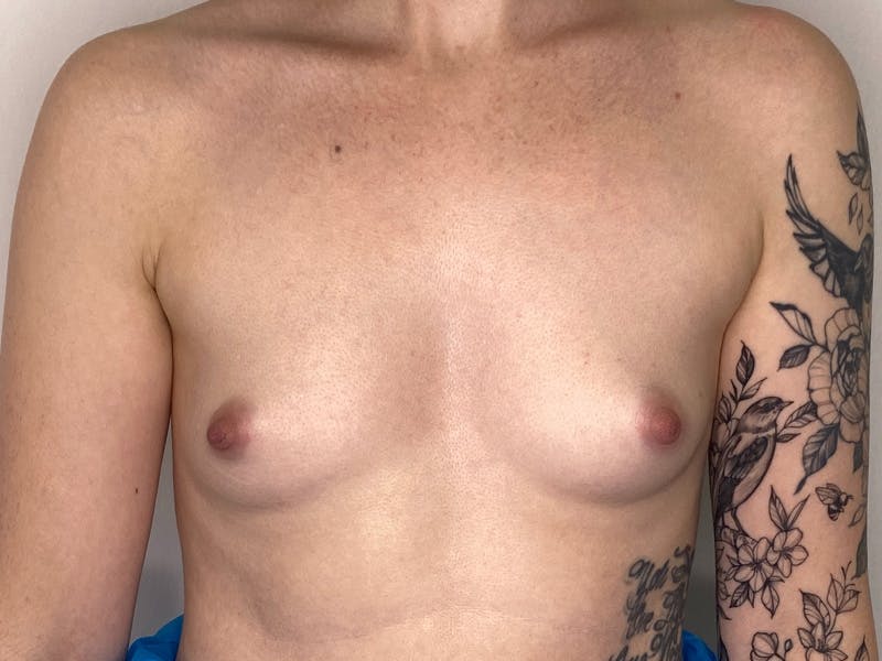Breast Augmentation Before & After Gallery - Patient 147376356 - Image 1