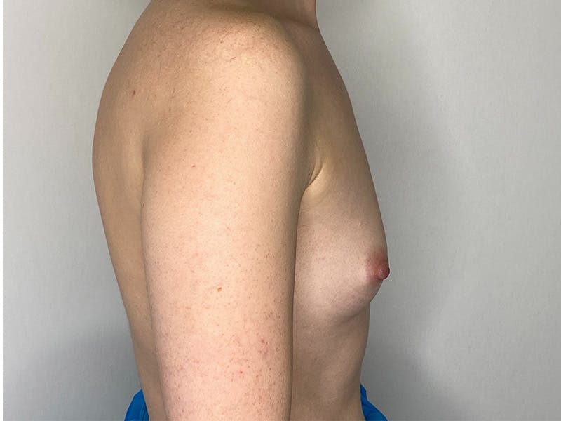 Breast Augmentation Before & After Gallery - Patient 147376356 - Image 7