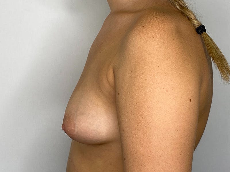 Breast Augmentation Before & After Gallery - Patient 147376355 - Image 9