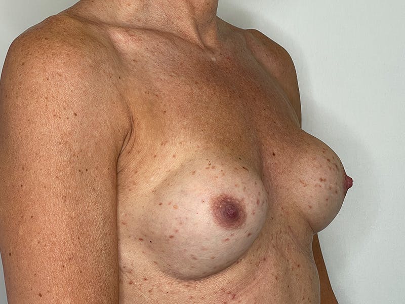 Fat Transfer Breast Enlargment Before & After Gallery - Patient 147376412 - Image 1