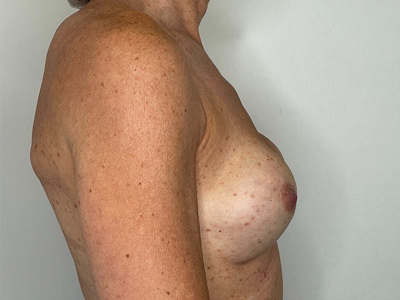 Fat Transfer Breast Enlargment Before & After Gallery - Patient 147376412 - Image 3