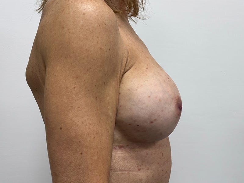 Fat Transfer Breast Enlargment Before & After Gallery - Patient 147376412 - Image 4
