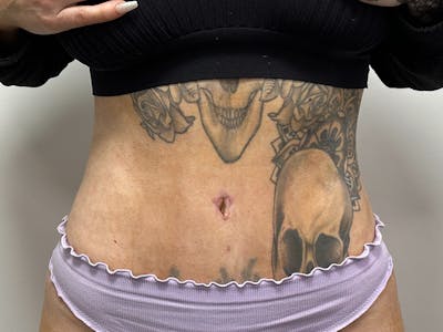 Tummy Tuck Before & After Gallery - Patient 147376423 - Image 2