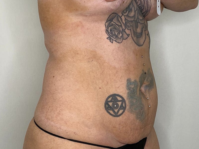 Tummy Tuck Before & After Gallery - Patient 147376423 - Image 3