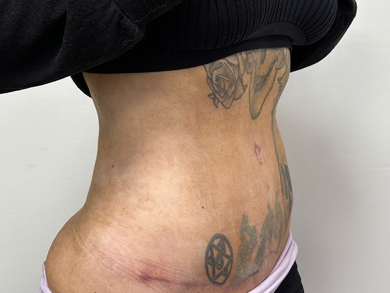 Tummy Tuck Before & After Gallery - Patient 147376423 - Image 4