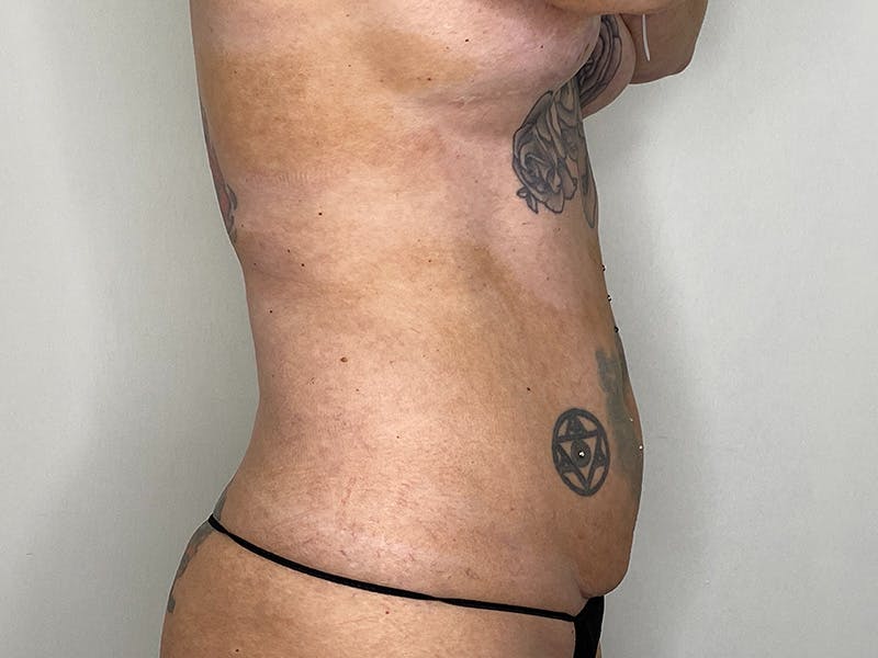 Tummy Tuck Before & After Gallery - Patient 147376423 - Image 5