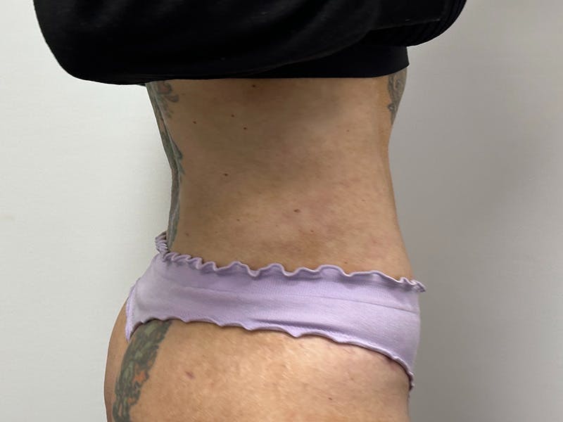 Tummy Tuck Before & After Gallery - Patient 147376423 - Image 6