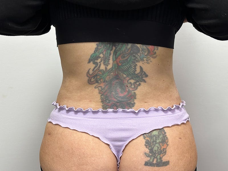 Tummy Tuck Before & After Gallery - Patient 147376423 - Image 8