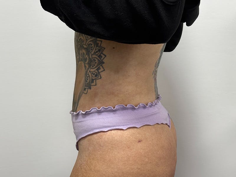 Tummy Tuck Before & After Gallery - Patient 147376423 - Image 12