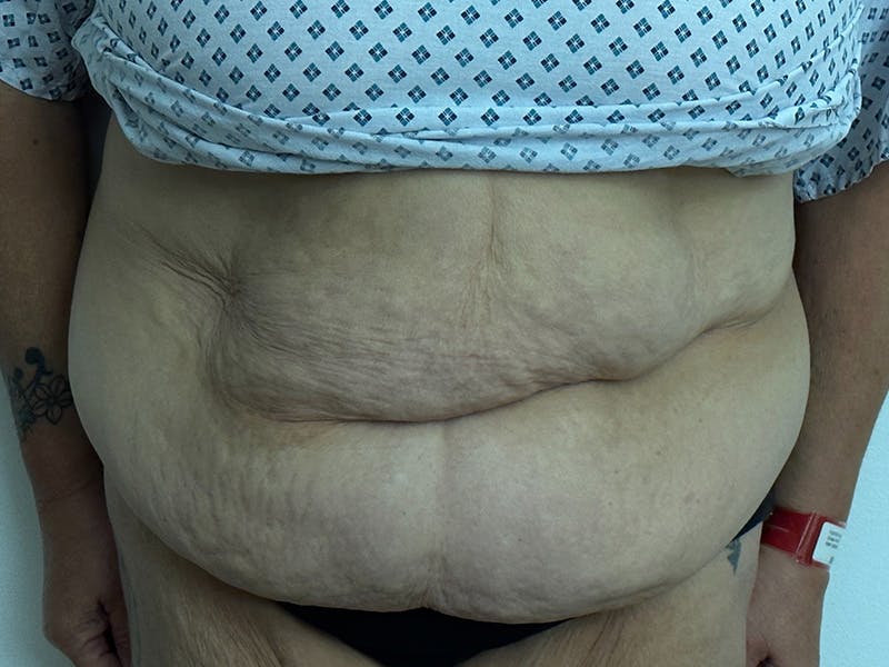 Tummy Tuck Before & After Gallery - Patient 147376490 - Image 1