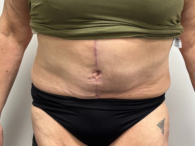 Tummy Tuck Before & After Gallery - Patient 147376490 - Image 2