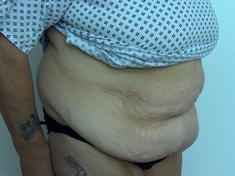 Tummy Tuck Before & After Gallery - Patient 147376490 - Image 3