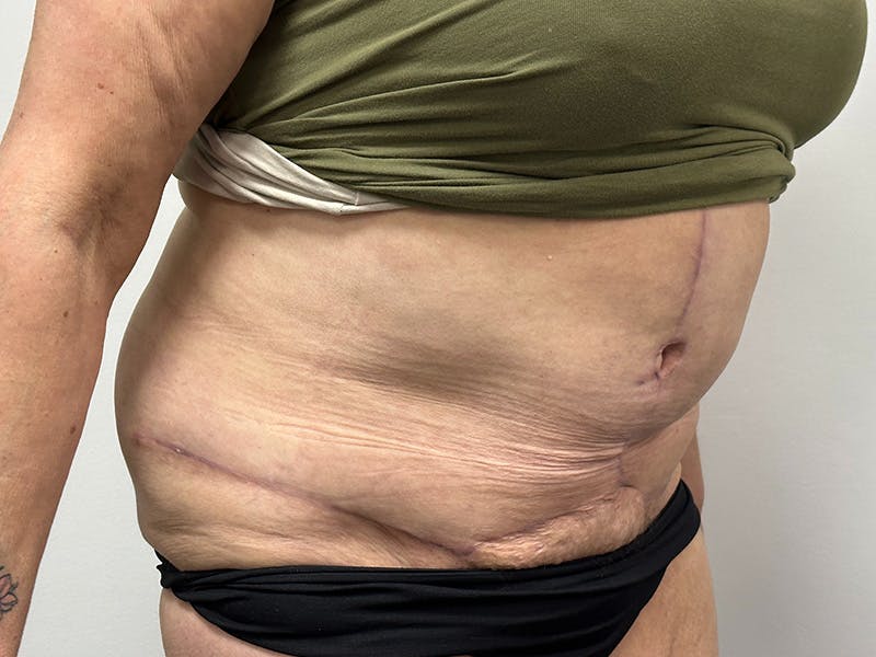 Tummy Tuck Before & After Gallery - Patient 147376490 - Image 4