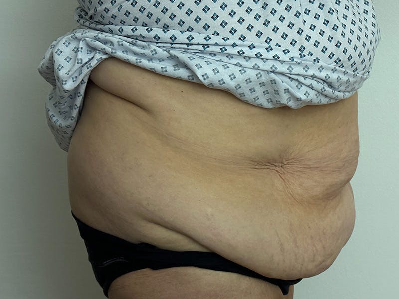 Tummy Tuck Before & After Gallery - Patient 147376490 - Image 5