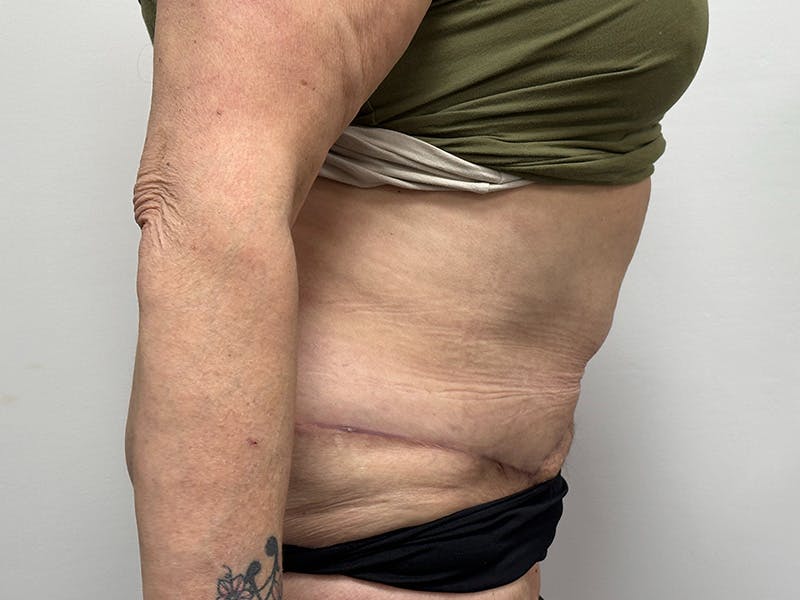 Tummy Tuck Before & After Gallery - Patient 147376490 - Image 6