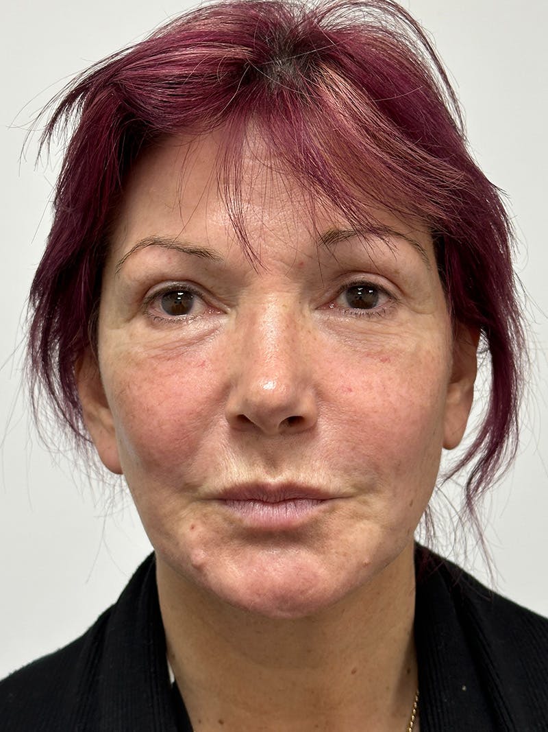 Facelift Before & After Gallery - Patient 147376507 - Image 1
