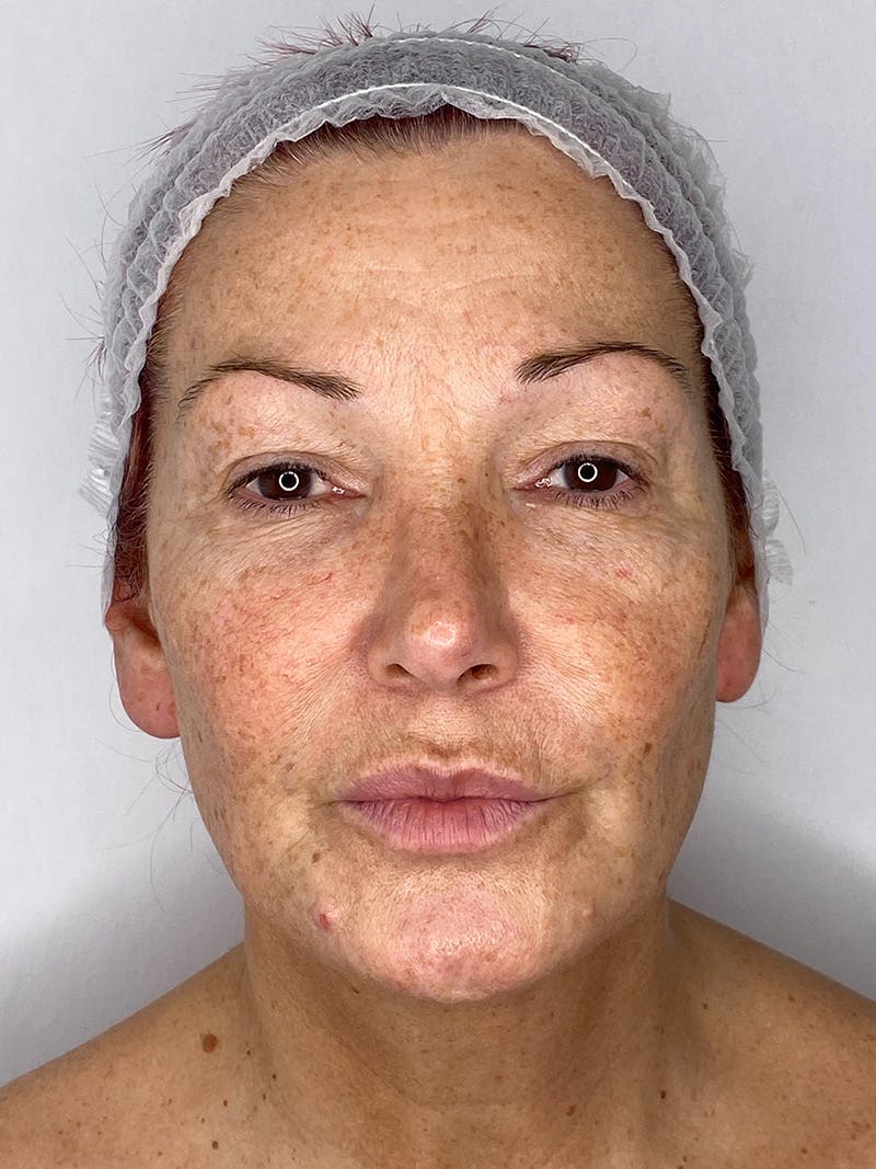 Facelift Before & After Gallery - Patient 147376507 - Image 1