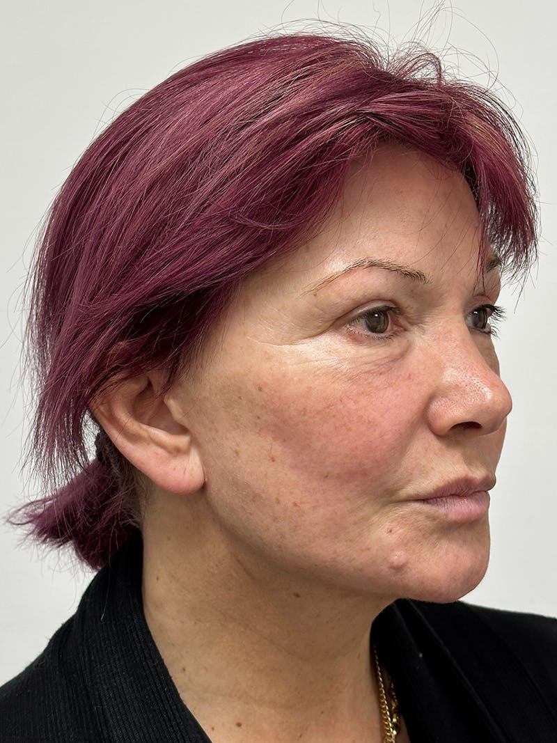 Facelift Before & After Gallery - Patient 147376507 - Image 4