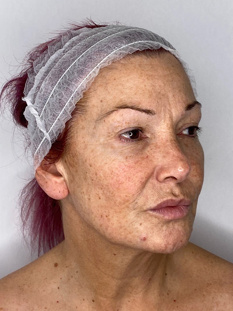 Facelift Before & After Gallery - Patient 147376507 - Image 3