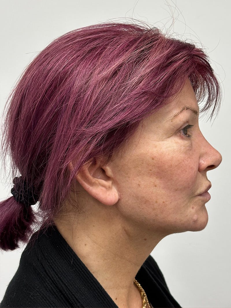 Facelift Before & After Gallery - Patient 147376507 - Image 6