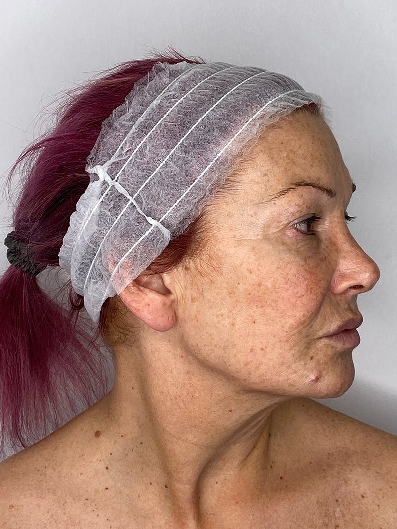 Facelift Before & After Gallery - Patient 147376507 - Image 5