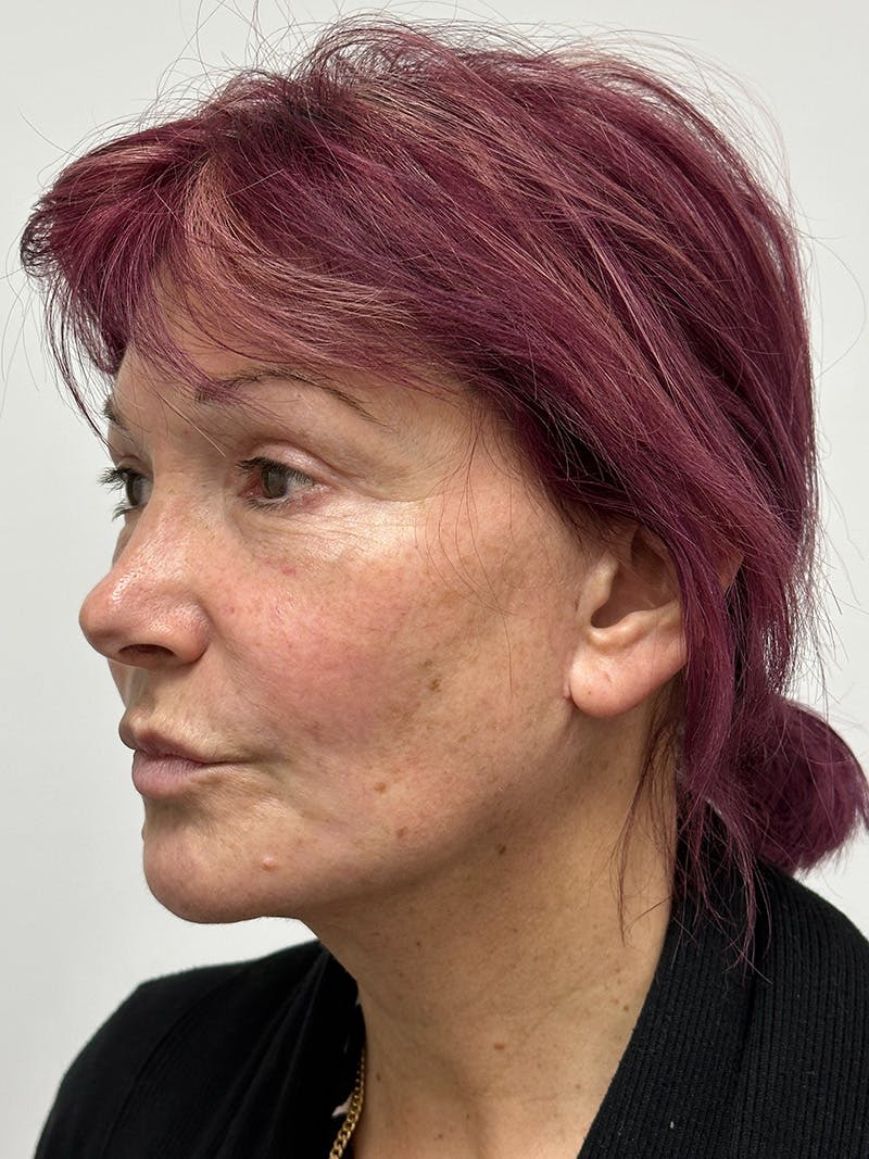 Facelift Before & After Gallery - Patient 147376507 - Image 8