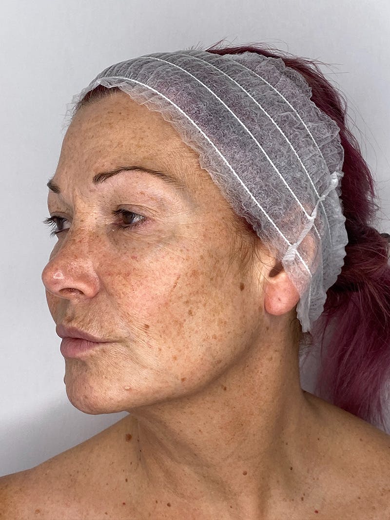 Facelift Before & After Gallery - Patient 147376507 - Image 8