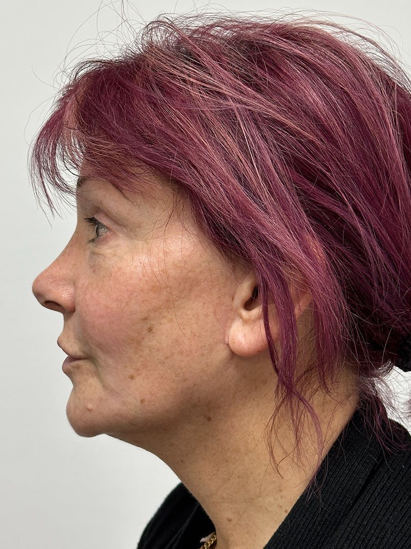 Facelift Before & After Gallery - Patient 147376507 - Image 9
