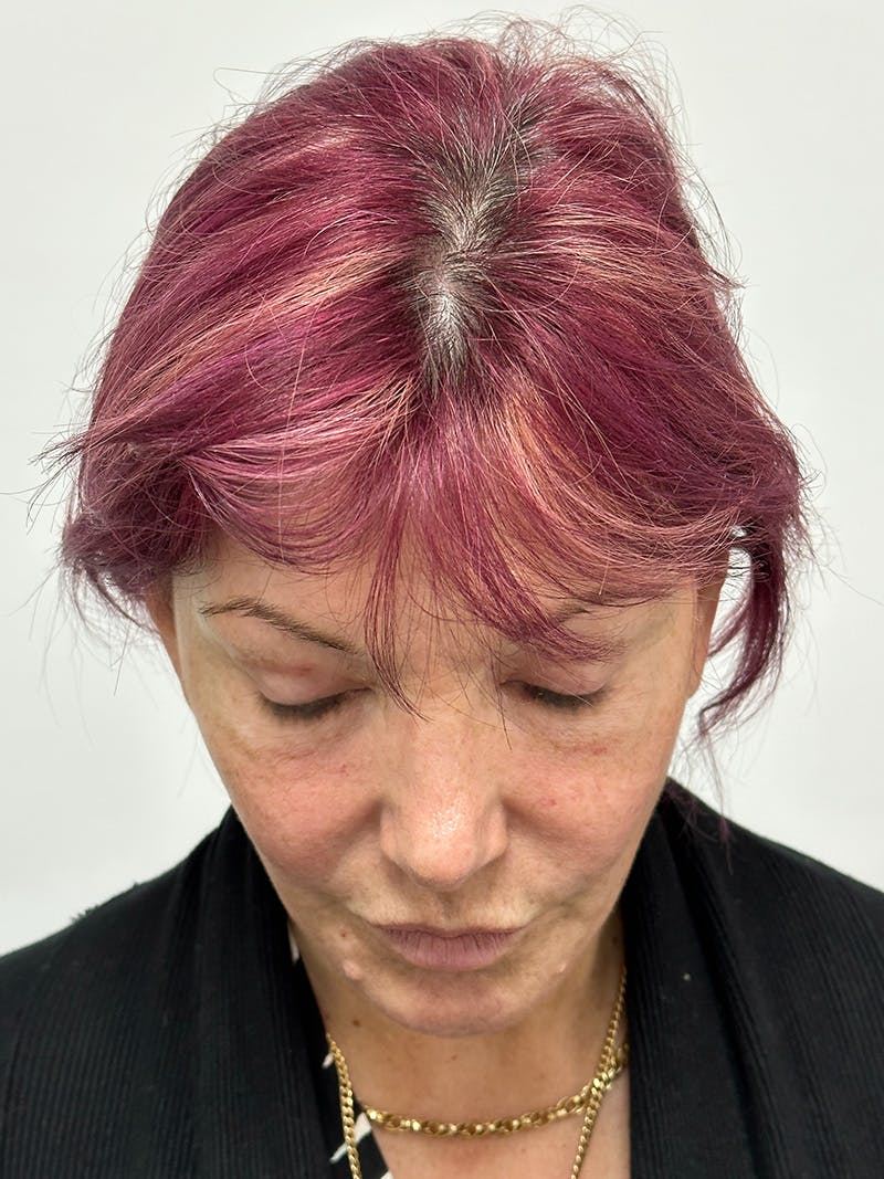 Facelift Before & After Gallery - Patient 147376507 - Image 12