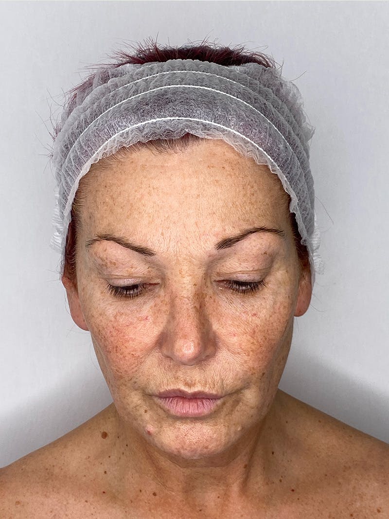 Facelift Before & After Gallery - Patient 147376507 - Image 12