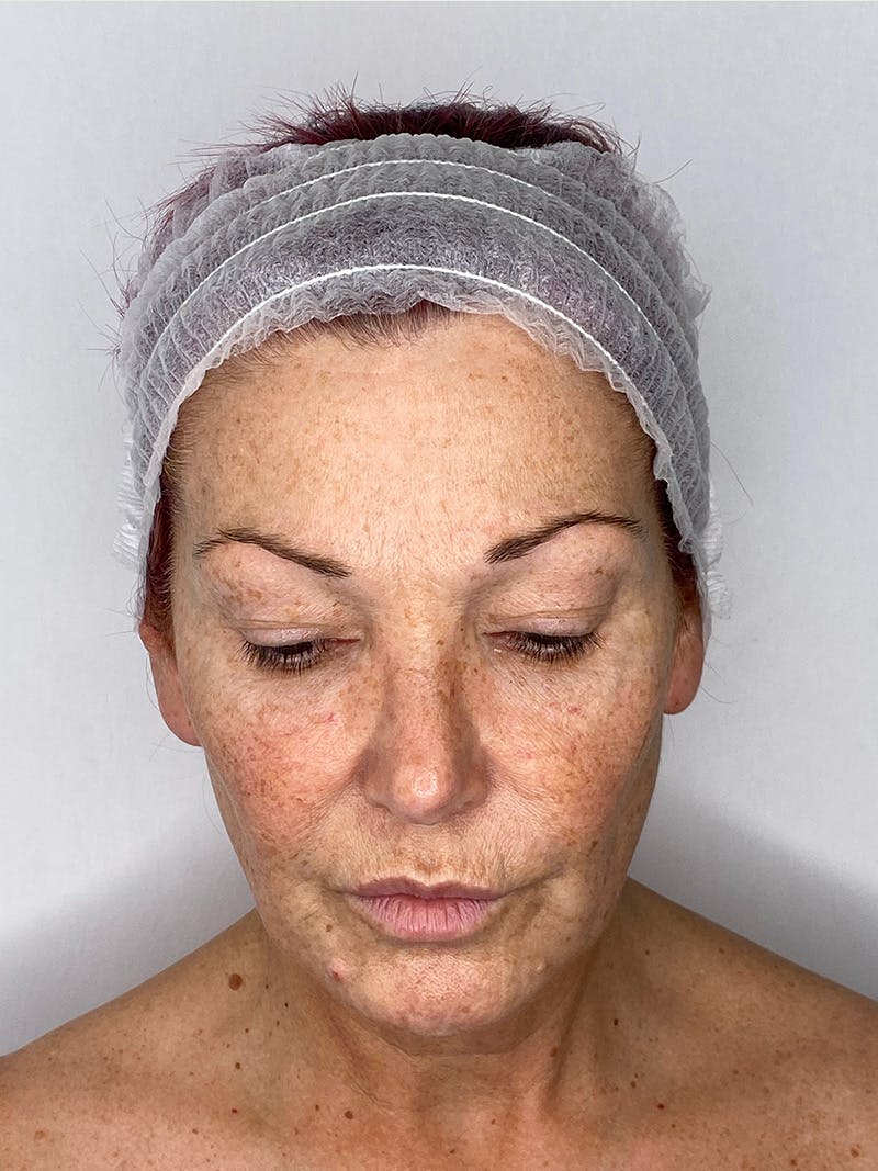 Facelift Before & After Gallery - Patient 147376507 - Image 11