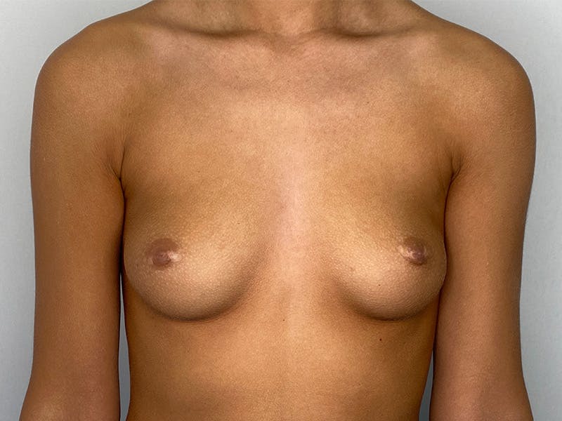 Breast Augmentation Before & After Gallery - Patient 148337603 - Image 1