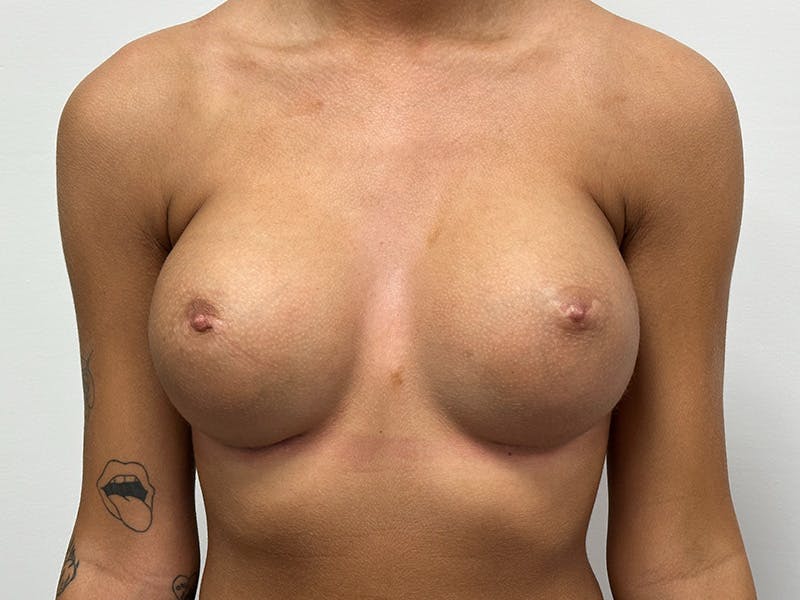 Breast Augmentation Before & After Gallery - Patient 148337603 - Image 2