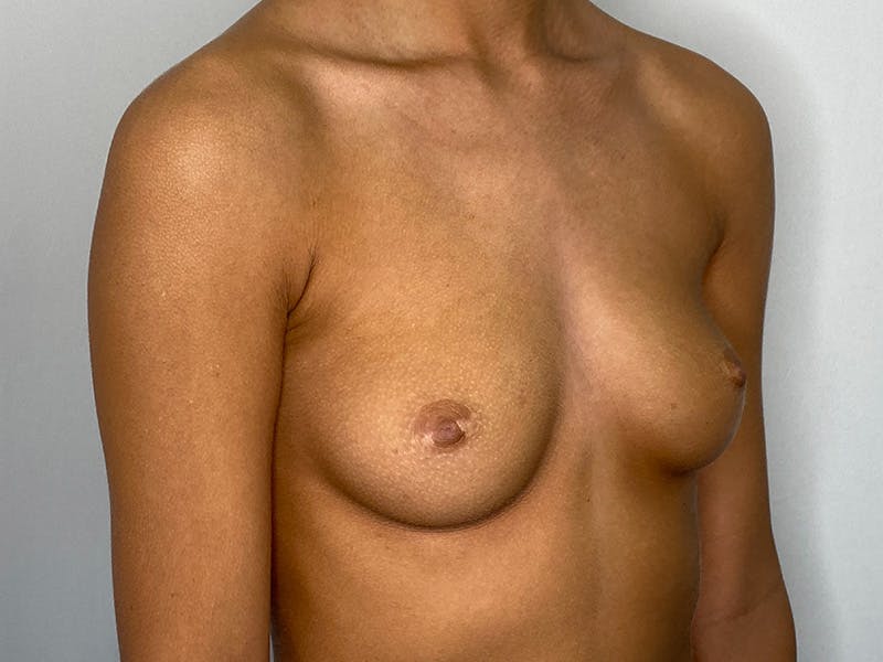 Breast Augmentation Before & After Gallery - Patient 148337603 - Image 3