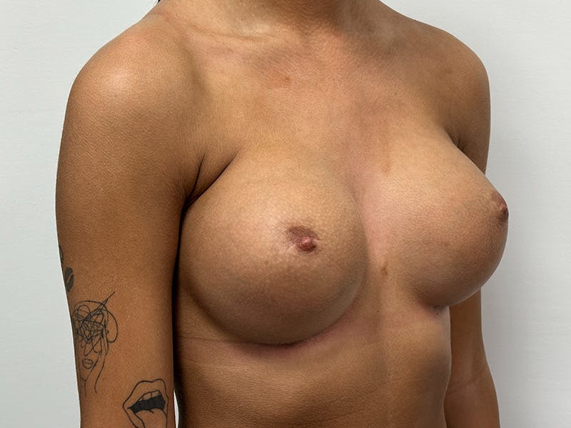 Breast Augmentation Before & After Gallery - Patient 148337603 - Image 4