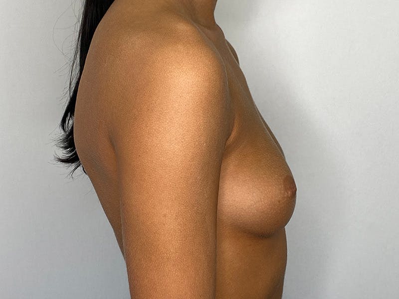 Breast Augmentation Before & After Gallery - Patient 148337603 - Image 5