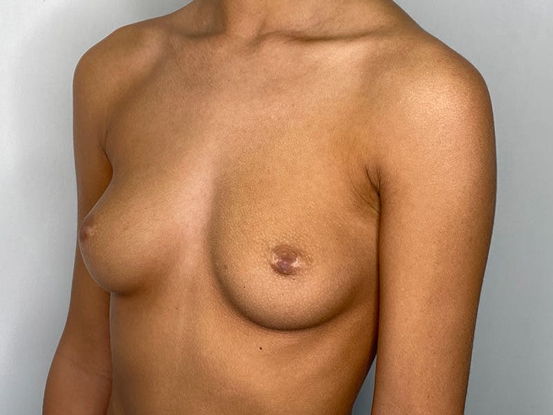 Breast Augmentation Before & After Gallery - Patient 148337603 - Image 7