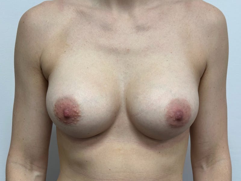 Breast Augmentation Before & After Gallery - Patient 148337619 - Image 2