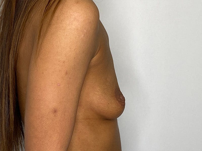 Breast Augmentation Before & After Gallery - Patient 148337614 - Image 5