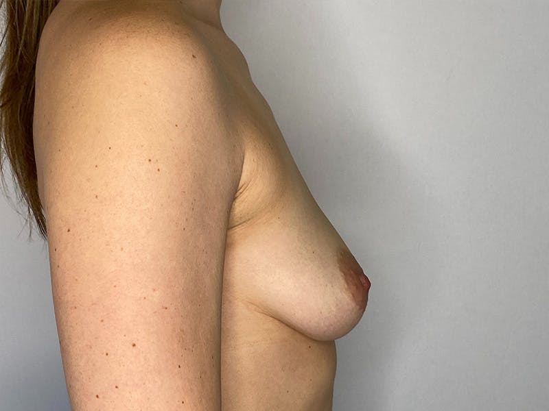 Breast Augmentation Before & After Gallery - Patient 148337619 - Image 5