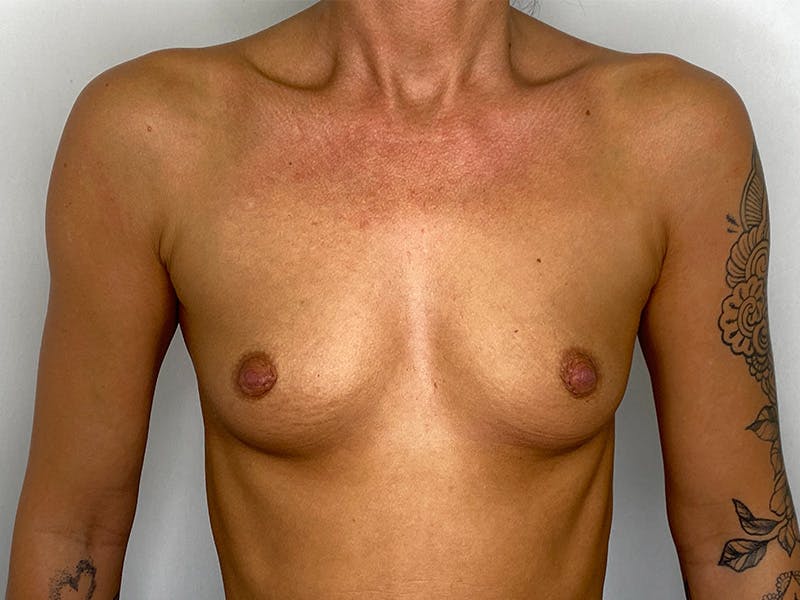 Breast Augmentation Before & After Gallery - Patient 148337615 - Image 1