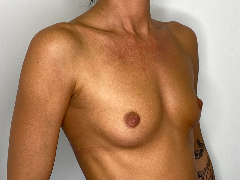 Breast Augmentation Before & After Gallery - Patient 148337615 - Image 3