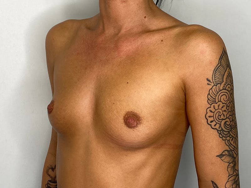 Breast Augmentation Before & After Gallery - Patient 148337615 - Image 7