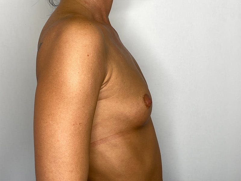 Breast Augmentation Before & After Gallery - Patient 148337615 - Image 5