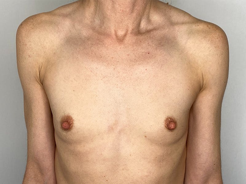 Breast Augmentation Before & After Gallery - Patient 148337613 - Image 1