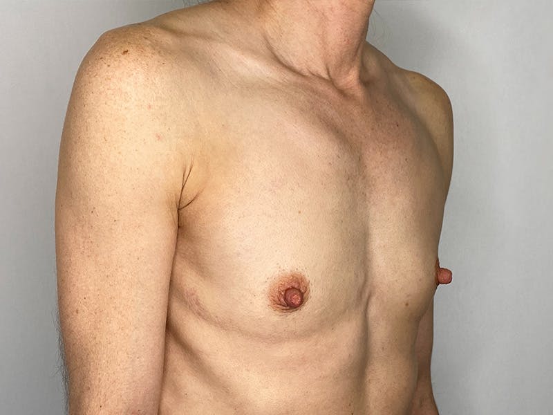 Breast Augmentation Before & After Gallery - Patient 148337613 - Image 3