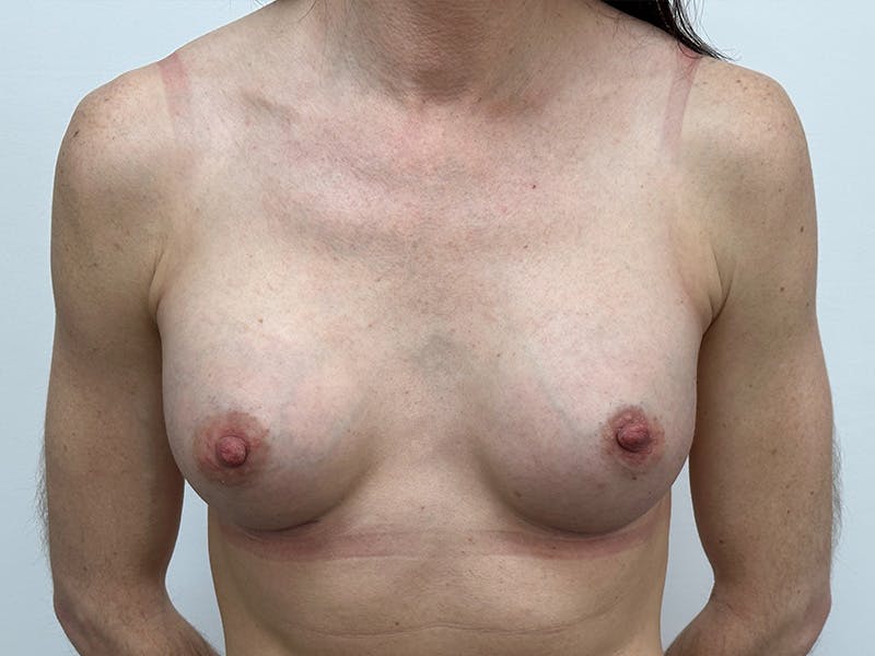 Breast Augmentation Before & After Gallery - Patient 148337613 - Image 2