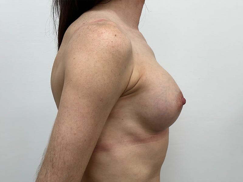 Breast Augmentation Before & After Gallery - Patient 148337613 - Image 6