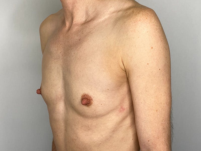 Breast Augmentation Before & After Gallery - Patient 148337613 - Image 7